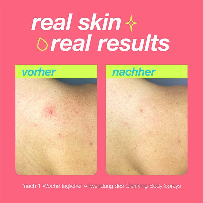 Clarifying Body Spray + Breakout Clearing Foaming Wash - Image 4